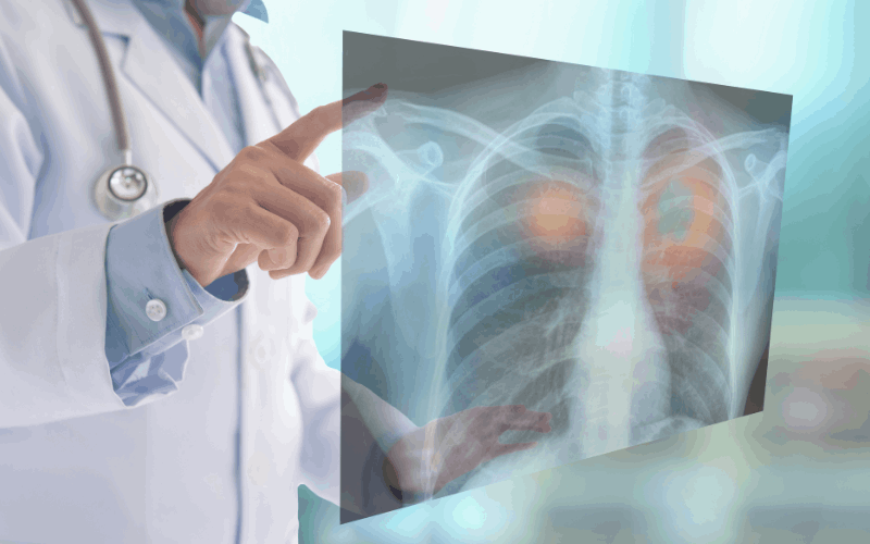 Lung Cancer Diagnosis? Get a Trusted Second Opinion Online